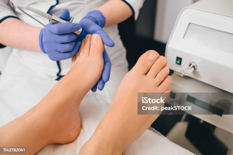 Onicomicosis(Eliminación de hongos en las uñas)