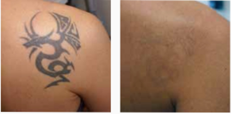 Eliminación de tatuajes y de micropigmentación de cejas